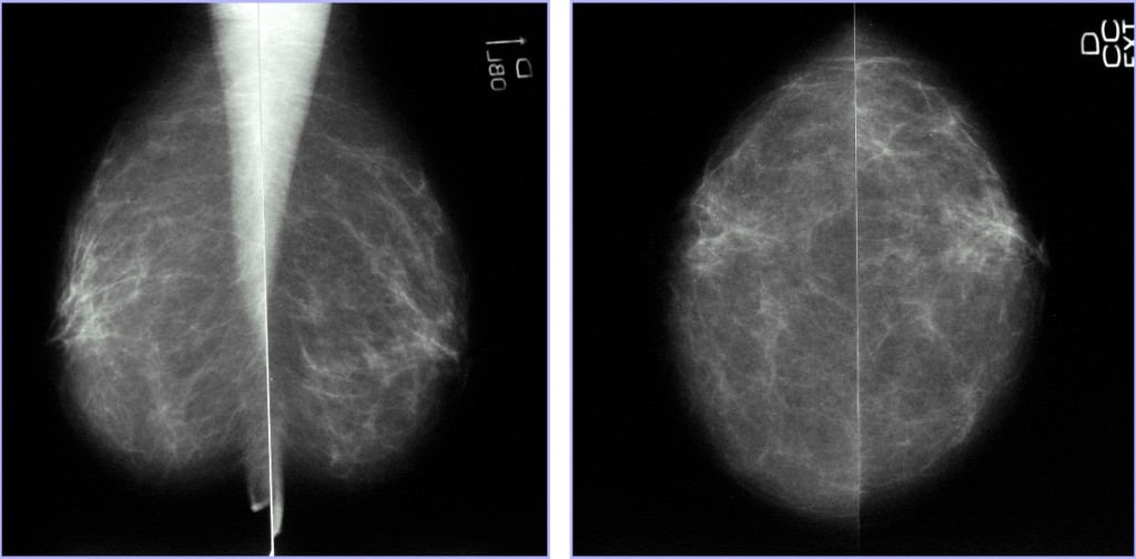Categoría BI-RADS® 1. Mamografía normal